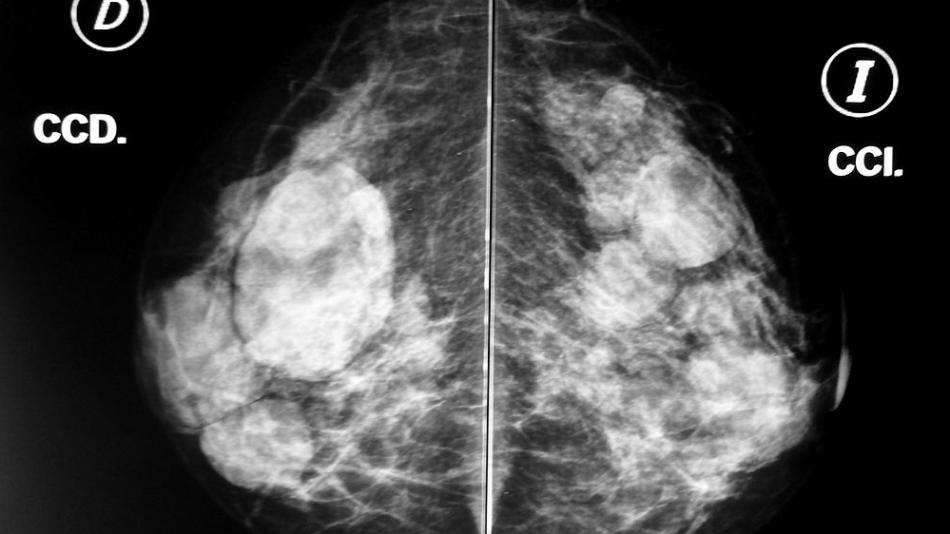 Nemocnice Sokolov koupí nový mamograf